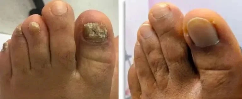 Cenessa - Tagliaunghie Elettrico Micosi™