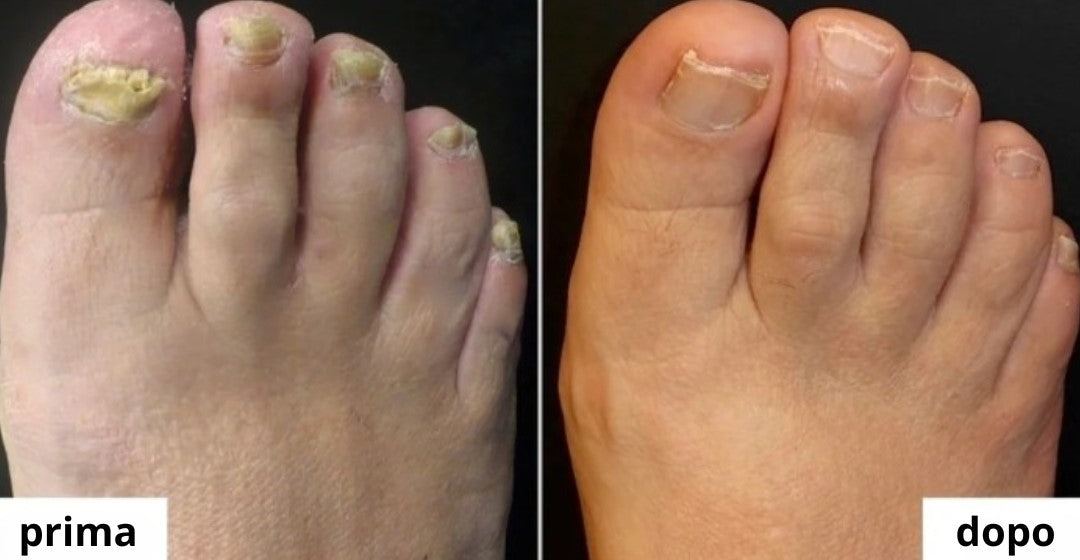 Cenessa - Tagliaunghie Elettrico Micosi™